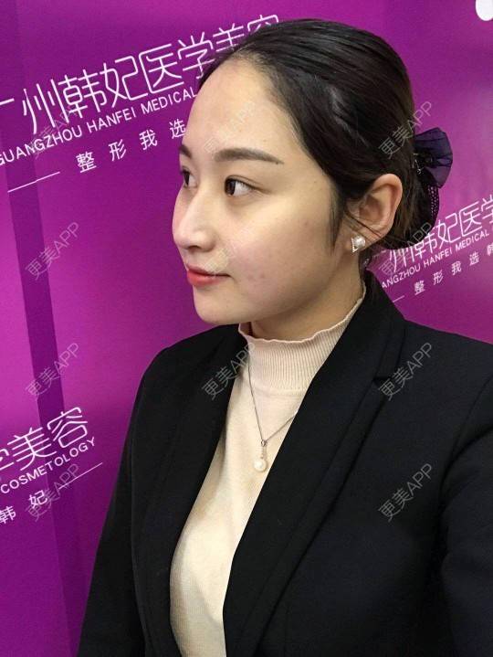 更美 - 深冬入暖的经验 | 埋线提升 | 广州