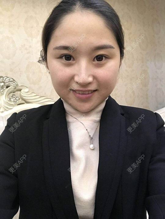 更美 - 深冬入暖的经验 | 埋线提升 | 广州