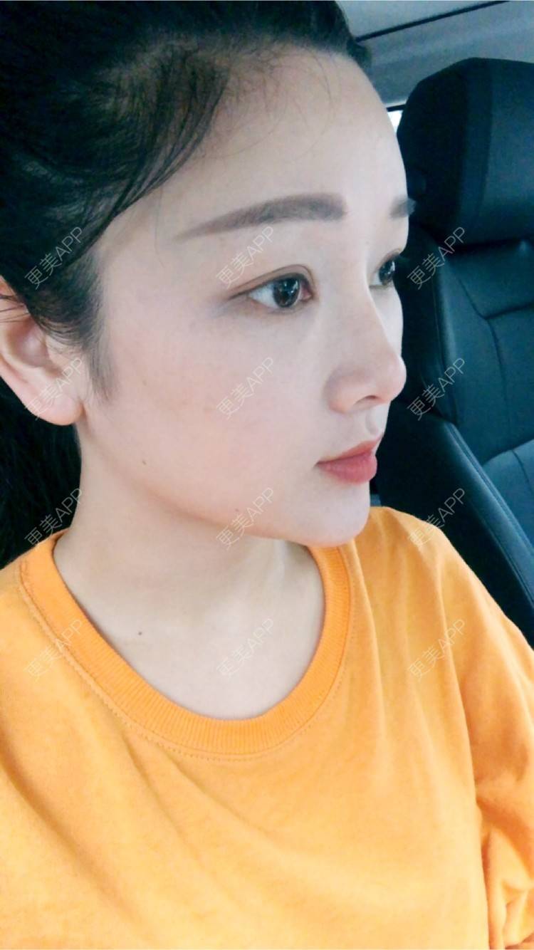 更美 - 更美用户GAjPFi8vPl的超声提升经验 | 丰胸（隆胸） | 瘦脸除皱 | 酒窝成形 | 玻尿酸卧蚕 | 水光项目 | 双眼皮 | 半永久纹眉 | 玻尿酸 | 处女膜修复 | 水氧活肤 | 美白嫩肤 | 超声提升 | 除皱瘦脸 | 埋线提升 | 皮秒激光 | 杭州