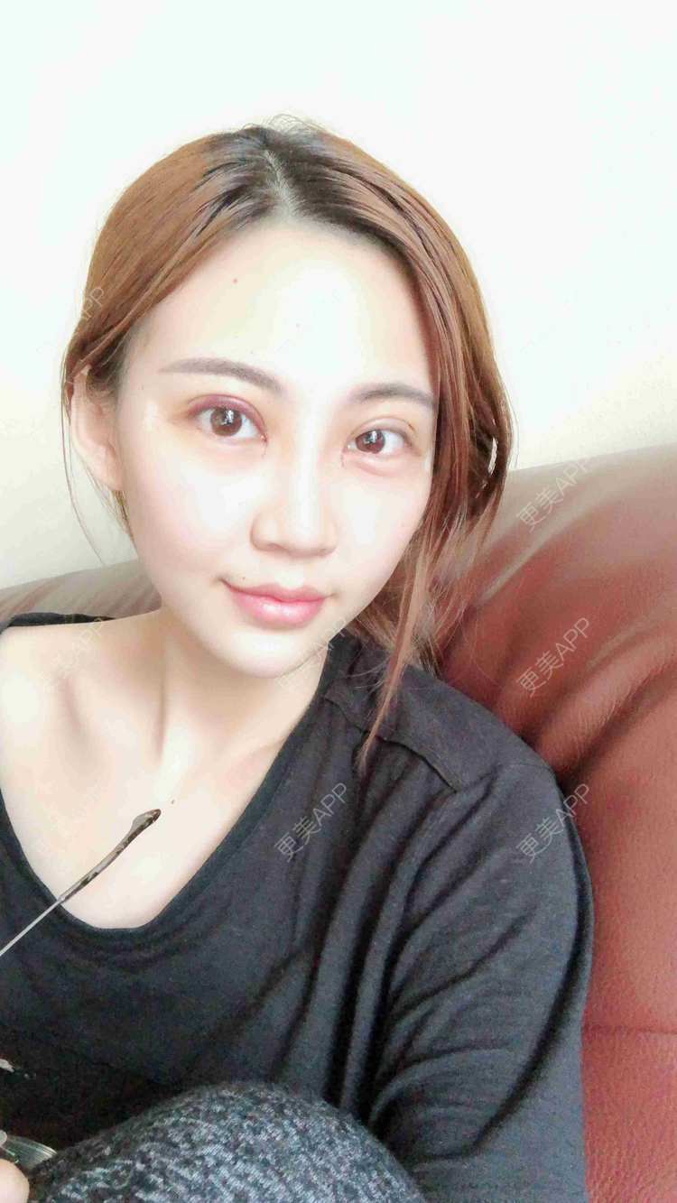 全切双眼皮效果图_文爱克 医生全切双眼皮效果图_术后55天__更美