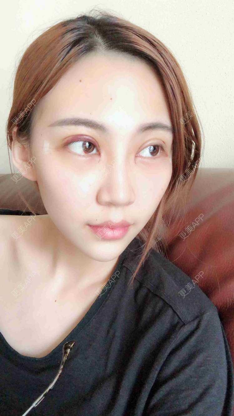 全切双眼皮效果图_文爱克 医生全切双眼皮效果图_术后55天__更美