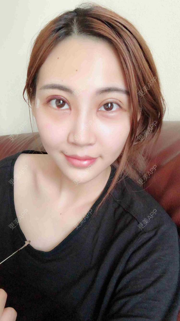 全切双眼皮效果图_文爱克 医生全切双眼皮效果图_术后55天__更美