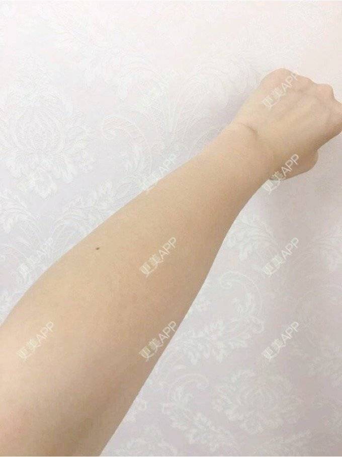 更美 - 更美用户8hdCTsM2qL的激光脱毛经验 | 南京 | 激光脱毛