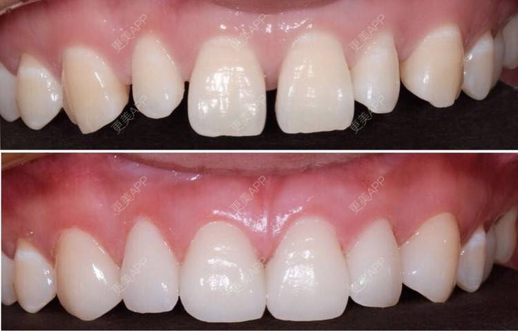 更美用户9k54vciyto的牙贴面日记