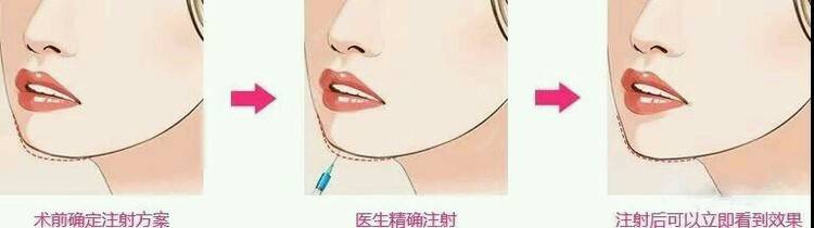 更美 - 刘晋元 医生的轮廓套餐经验 | 太原 | 轮廓套餐