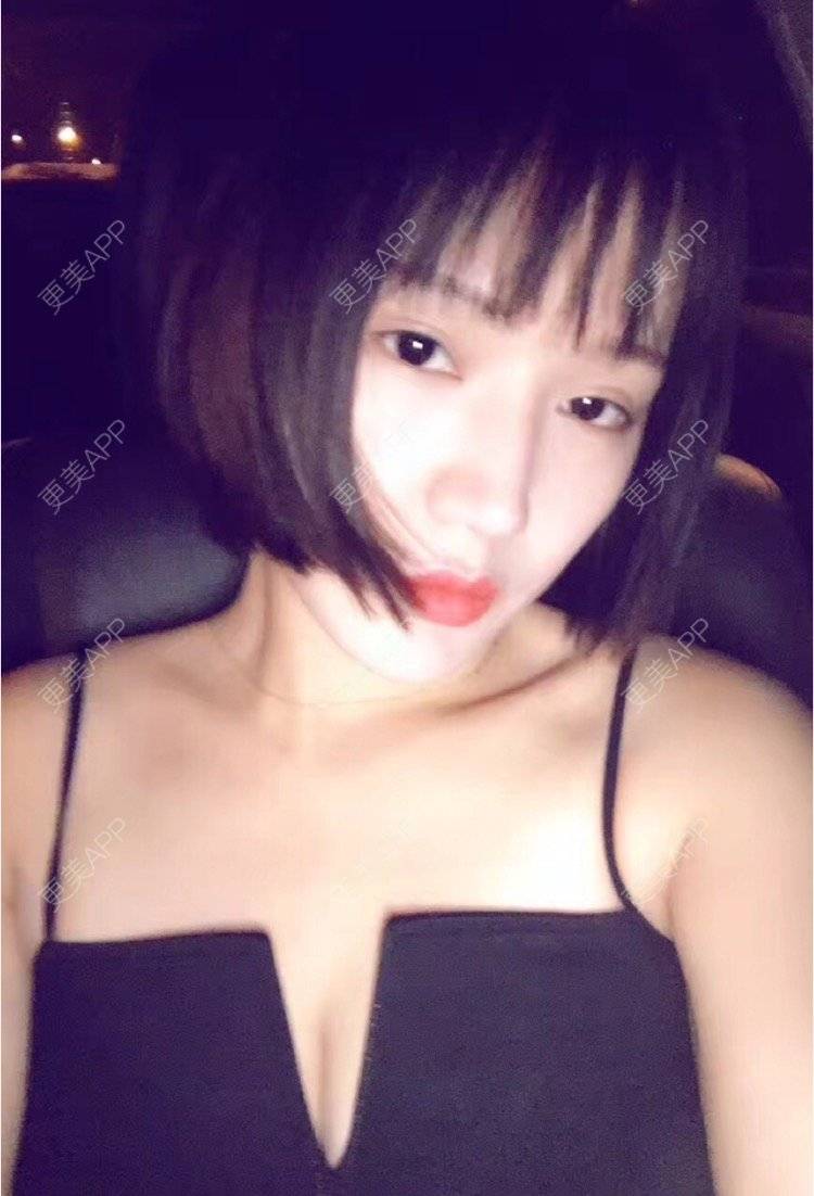 更美 - 更美用户Bi9obEIP28的膨体隆鼻经验 | 北京 | 水光项目 | 双眼皮 | 福州 | 武汉 | 长沙 | 广州 | 半永久纹眉 | 深圳 | 吸脂 | 南宁 | 成都 | 祛斑祛色素 | 水氧活肤 | 膨体隆鼻 | 埋线提升 | 瘦脸除皱 | 除皱瘦脸 | 冷冻溶脂 | 皮秒激光 | 玻尿酸 | 硅胶垫下巴