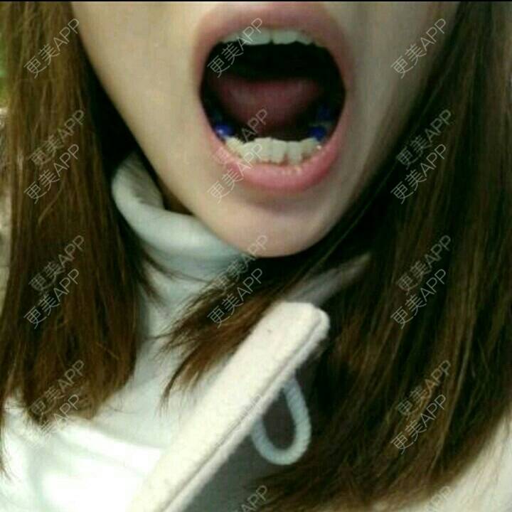 更美 - 更美用户gisE2nk9aj的牙齿矫正经验 | 小气泡 | 自体脂肪面部年轻化 | 激光脱毛 | 北京 | 上海 | 武汉 | 超声波洗牙 | 牙齿矫正 | 沈阳 | 深圳 | 全瓷牙