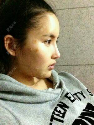 更美 - 南昌南大医美医疗美容的自体脂肪丰面颊经验 | 自体脂肪丰面颊