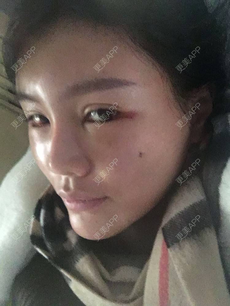 更美 - 十点差三分的时候开始的自体脂肪丰苹果肌经验 | 自体脂肪丰苹果肌 | 假体垫苹果肌