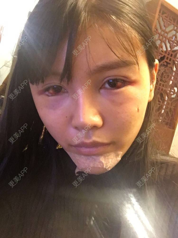 更美 - 十点差三分的时候开始的自体脂肪丰苹果肌经验 | 自体脂肪丰苹果肌 | 假体垫苹果肌