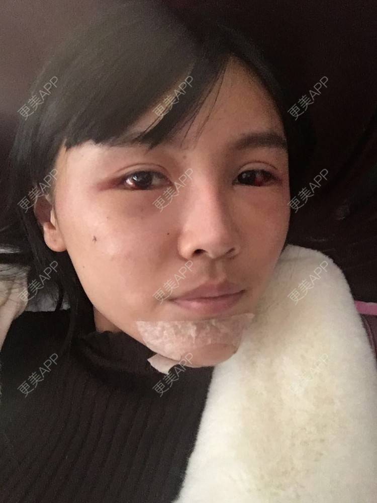 更美 - 十点差三分的时候开始的自体脂肪丰苹果肌经验 | 自体脂肪丰苹果肌 | 假体垫苹果肌
