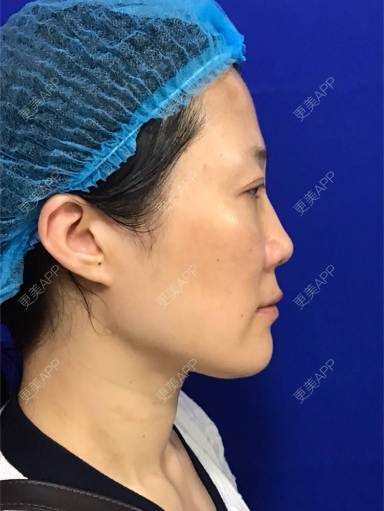 更美 - 舒怡的经验 | 自体脂肪隆胸 | 自体脂肪丰太阳穴 | 硅胶隆鼻 | 水光项目 | 牙齿矫正 | 双眼皮 | 上海 | 北京 | 除皱瘦脸 | 武汉 | 埋线提升 | 长沙 | 广州 | 牙贴面 | 深圳 | 南昌 | 南京 | 鼻部综合