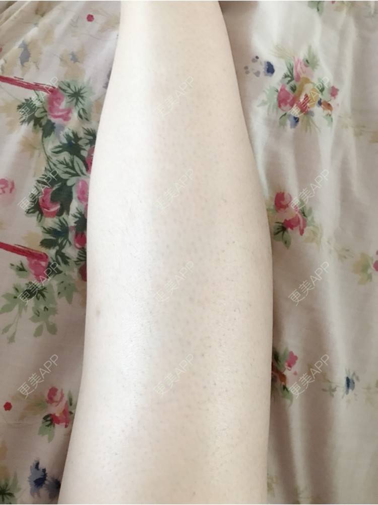 更美 - 7815欣欣然的注射塑形腿部日记 | 青岛 | 注射塑形腿部