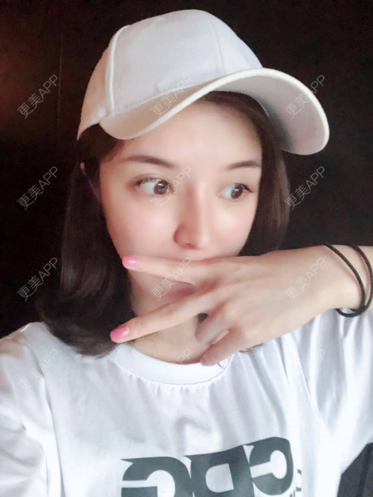更美 - 罗莉 医生的鼻部多项经验 | 鼻翼 | 福州 | 隆鼻 | 鼻部多项