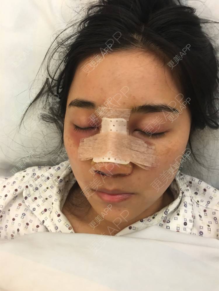 更美 - 更美用户2MN53iOvzL的驼峰鼻矫正经验 | 线雕隆鼻术后修复 | 驼峰鼻矫正 | 杭州