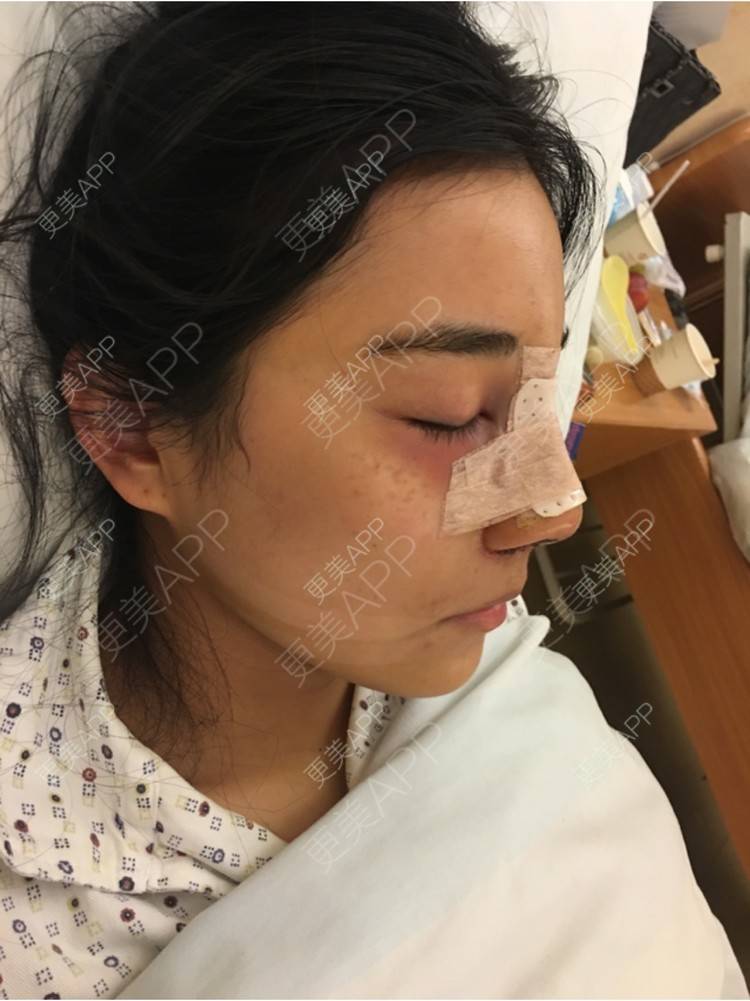 更美 - 更美用户2MN53iOvzL的驼峰鼻矫正经验 | 线雕隆鼻术后修复 | 驼峰鼻矫正 | 杭州