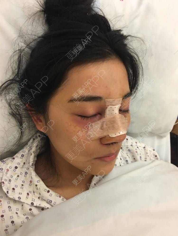 更美 - 更美用户2MN53iOvzL的驼峰鼻矫正经验 | 线雕隆鼻术后修复 | 驼峰鼻矫正 | 杭州