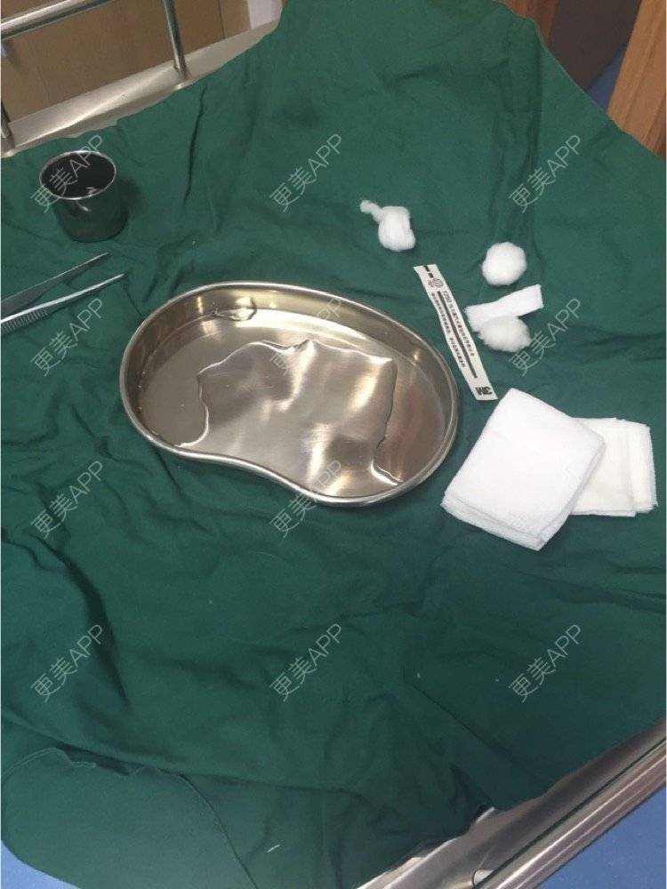 更美 - 超级飞侠1的玻尿酸颈纹经验 | 玻尿酸颈纹 | 重庆