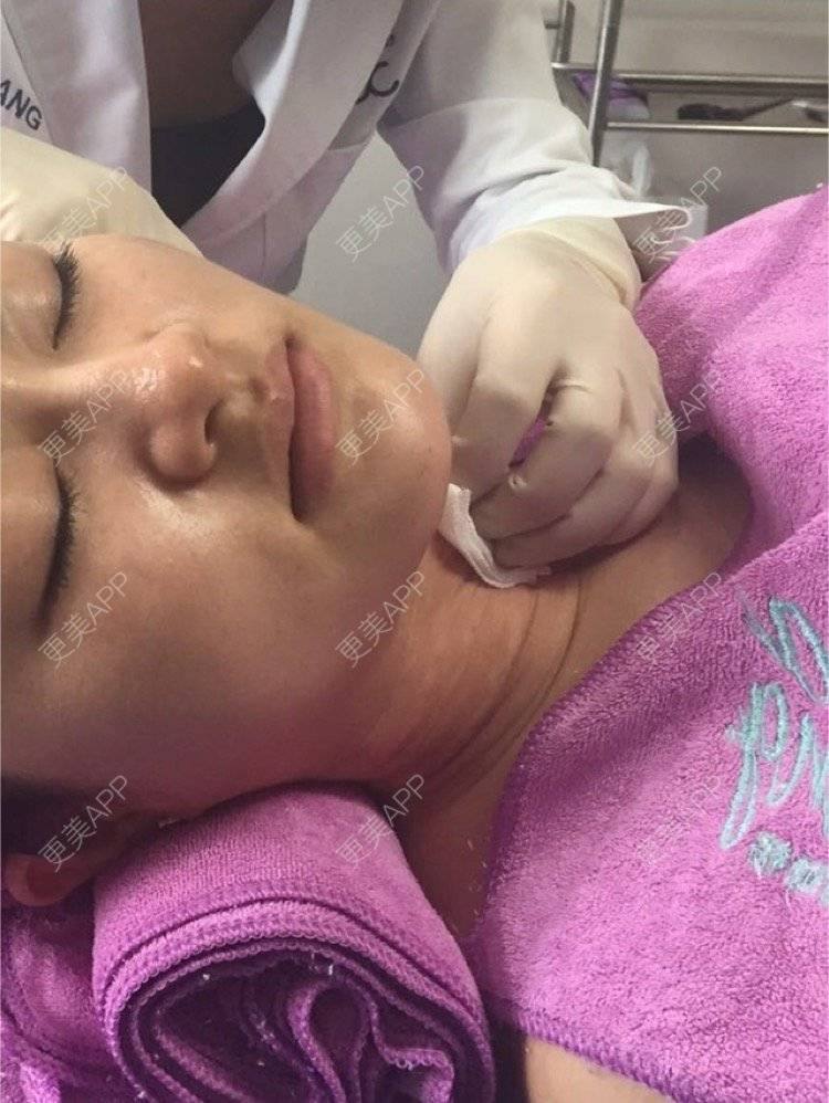 更美 - 超级飞侠1的玻尿酸颈纹经验 | 玻尿酸颈纹 | 重庆