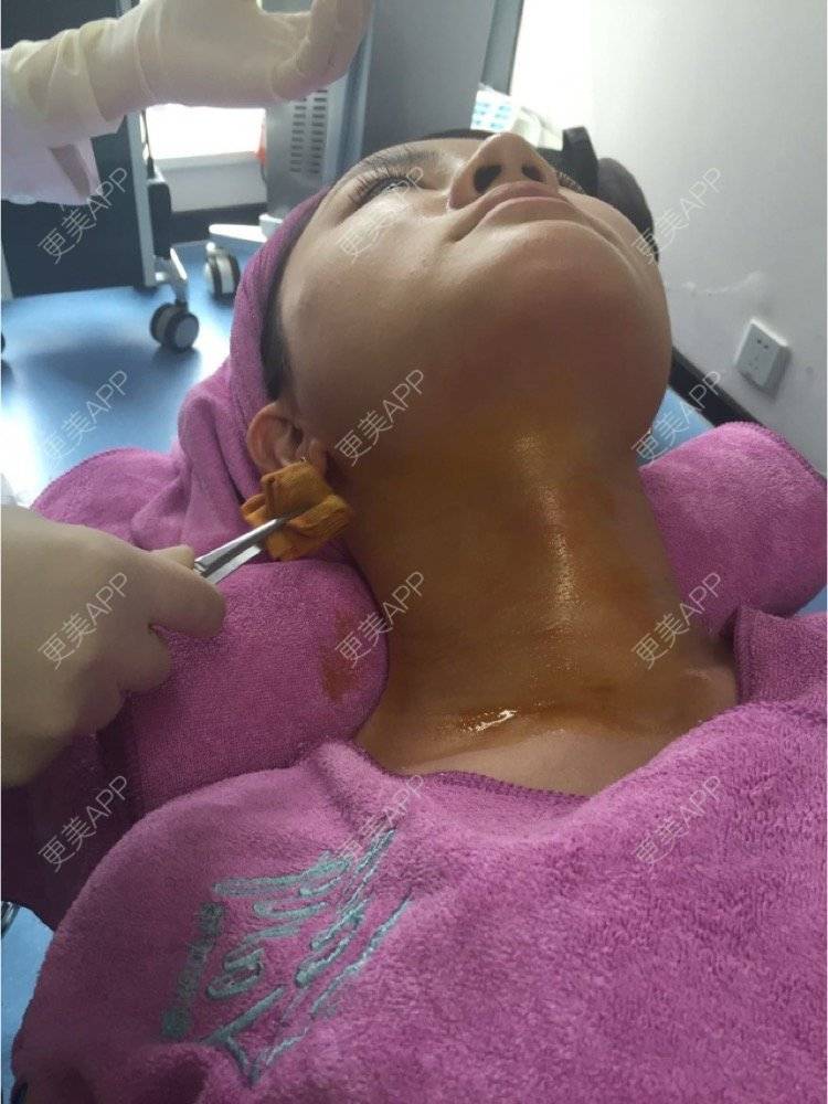 更美 - 超级飞侠1的玻尿酸颈纹经验 | 玻尿酸颈纹 | 重庆