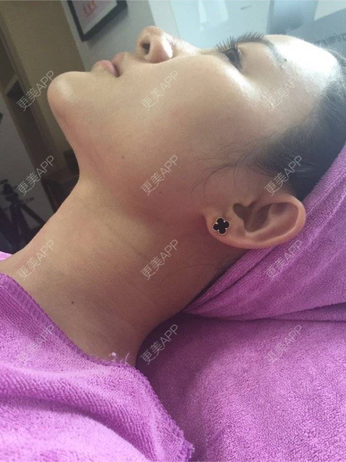 更美 - 超级飞侠1的玻尿酸颈纹经验 | 玻尿酸颈纹 | 重庆