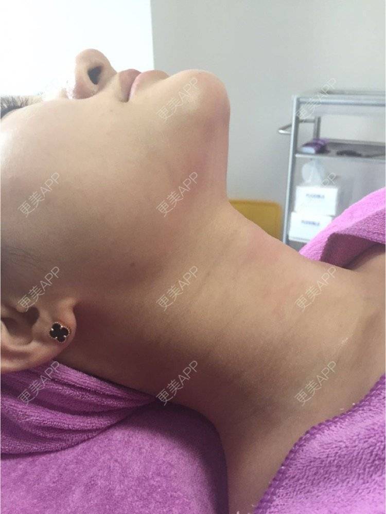 更美 - 超级飞侠1的玻尿酸颈纹经验 | 玻尿酸颈纹 | 重庆