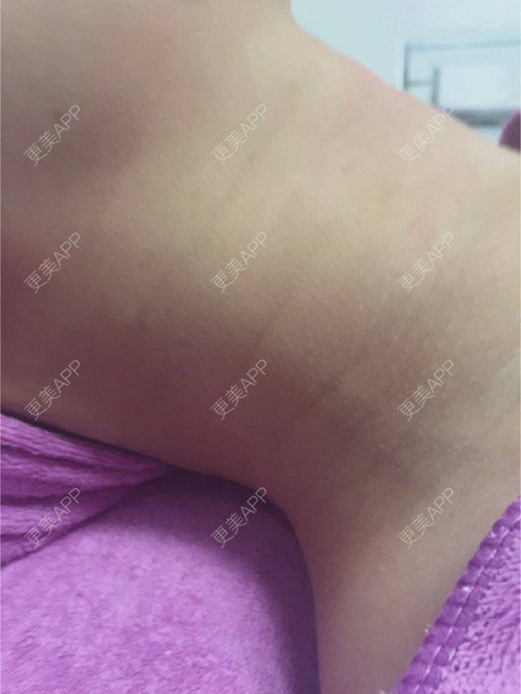 更美 - 超级飞侠1的玻尿酸颈纹经验 | 玻尿酸颈纹 | 重庆