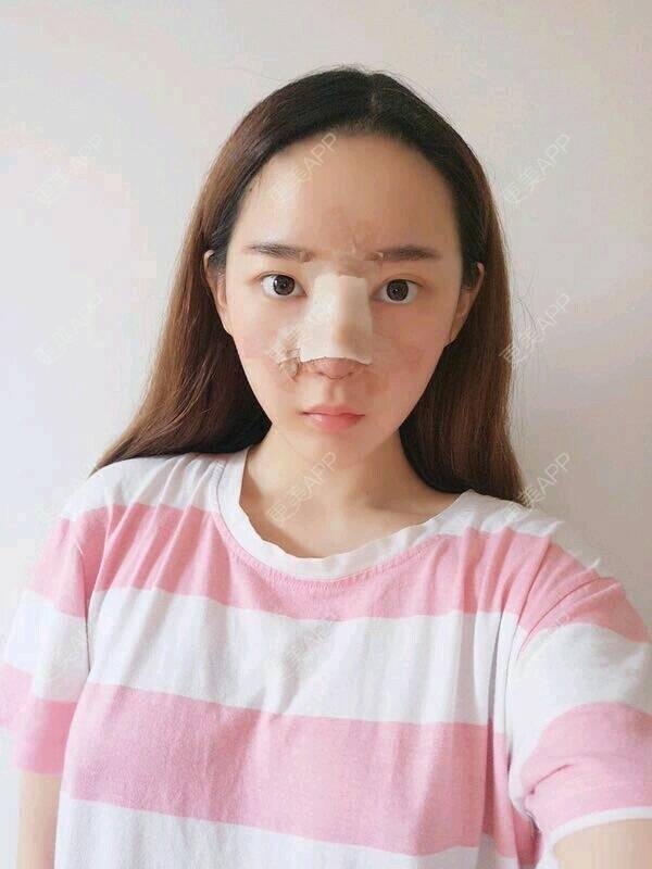 更美 - 倾尽一生deng的鼻部综合经验 | 鼻形态修复 | 重庆 | 鼻部综合 | 隆鼻 | 视频日记