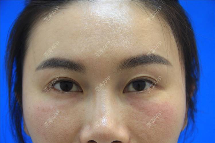 更美 - 厦门欧菲医疗美容医院的胶原蛋白淡化黑眼圈经验 | 厦门 | 胶原蛋白淡化黑眼圈