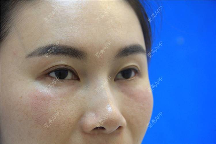 更美 - 厦门欧菲医疗美容医院的胶原蛋白淡化黑眼圈经验 | 厦门 | 胶原蛋白淡化黑眼圈