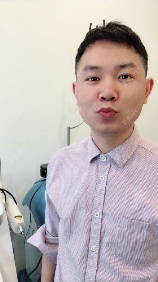 更美 - 小小祥子的M唇成形经验 | M唇成形 | 视频日记 | 重庆 | 厚唇改薄 | 唇综合