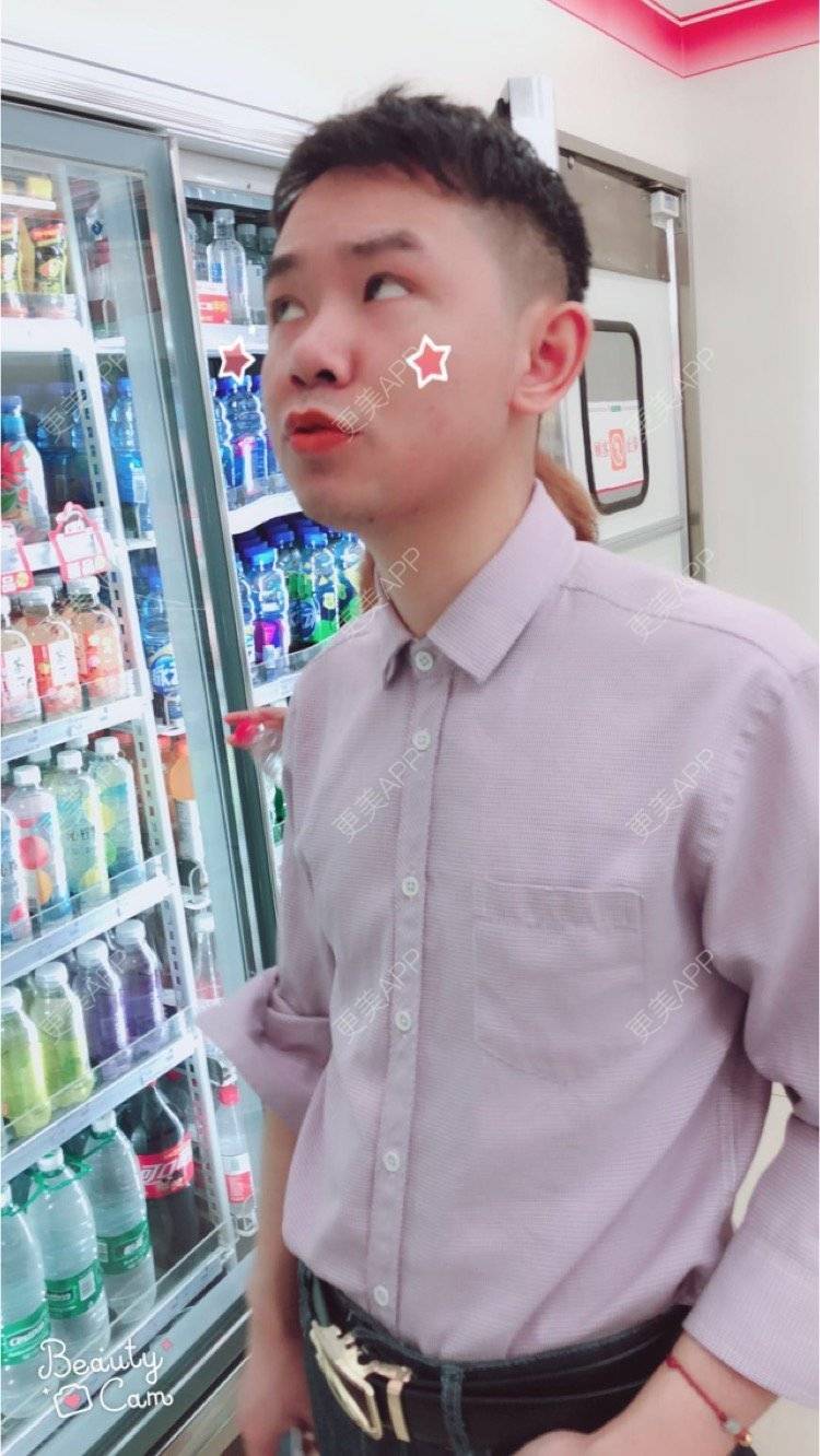 更美 - 小小祥子的M唇成形经验 | M唇成形 | 视频日记 | 重庆 | 厚唇改薄 | 唇综合