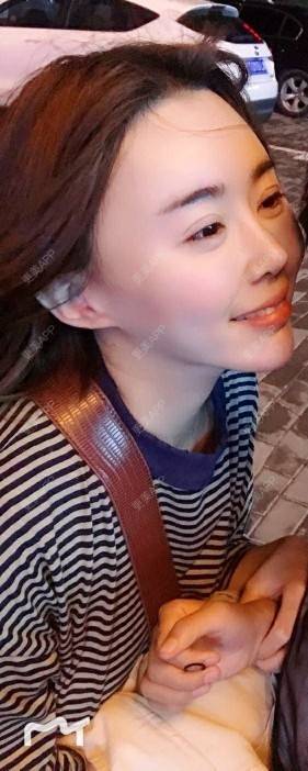 更美 - 打不过我吧的硅胶隆鼻经验 | 硅胶隆鼻 | 濮阳