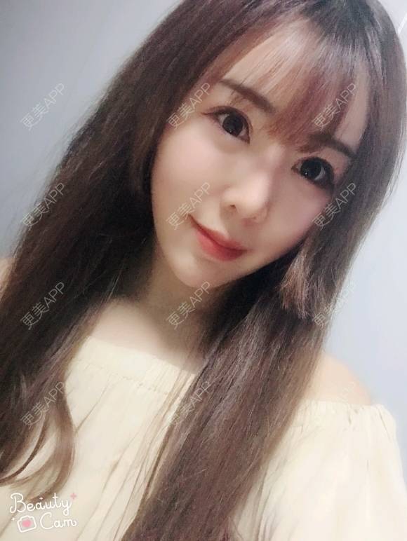 更美 - 打不过我吧的硅胶隆鼻经验 | 硅胶隆鼻 | 濮阳