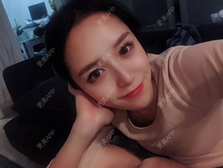 更美 - 请叫我灰姑娘GAO的果酸焕肤经验 | 视频日记 | 南宁 | 果酸焕肤