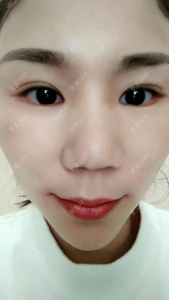 更美用户p42a4qjw06的开眼角日记