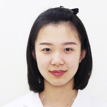 【石家庄@段珊珊】埋线双眼皮