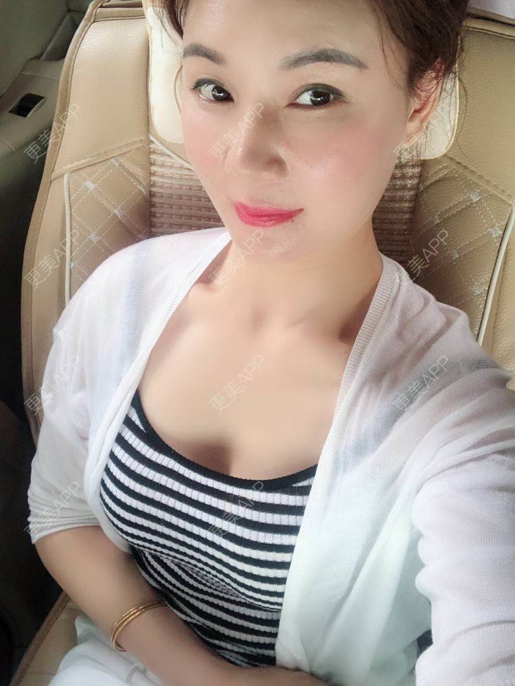 花溪的自体脂肪隆胸日记