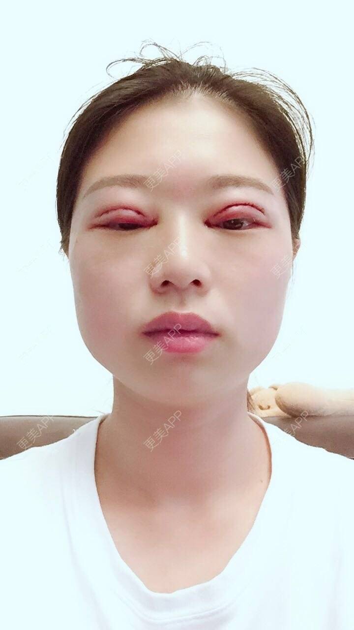 镜雪墨书的全切双眼皮日记