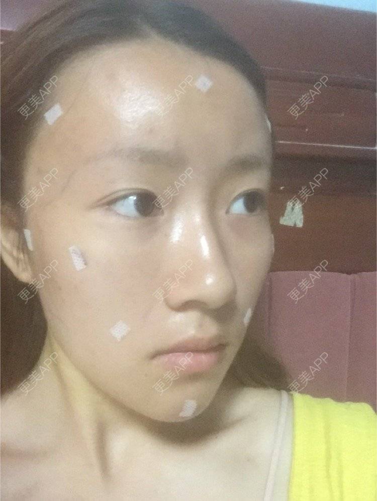 更美 - 爱上太阳的橙子的经验 | 像素激光 | 鼻部多项 | 宁波 | 重庆 | 北京 | 激光脱毛 | 眼部多项 | 隆鼻 | 武汉 | 广州 | 牙贴面 | 常州 | 吸脂瘦脸 | 玻尿酸