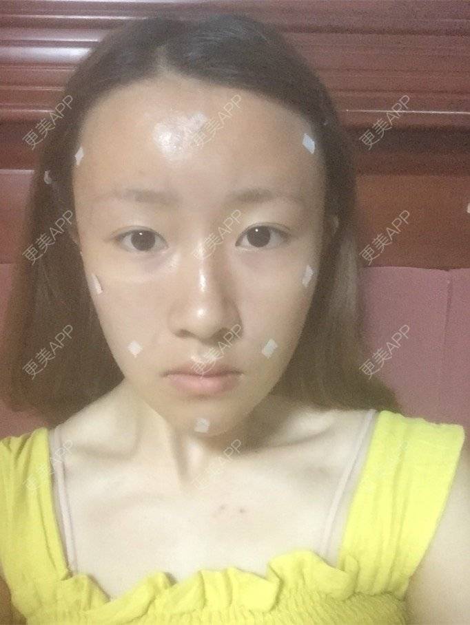 更美 - 爱上太阳的橙子的经验 | 像素激光 | 鼻部多项 | 宁波 | 重庆 | 北京 | 激光脱毛 | 眼部多项 | 隆鼻 | 武汉 | 广州 | 牙贴面 | 常州 | 吸脂瘦脸 | 玻尿酸