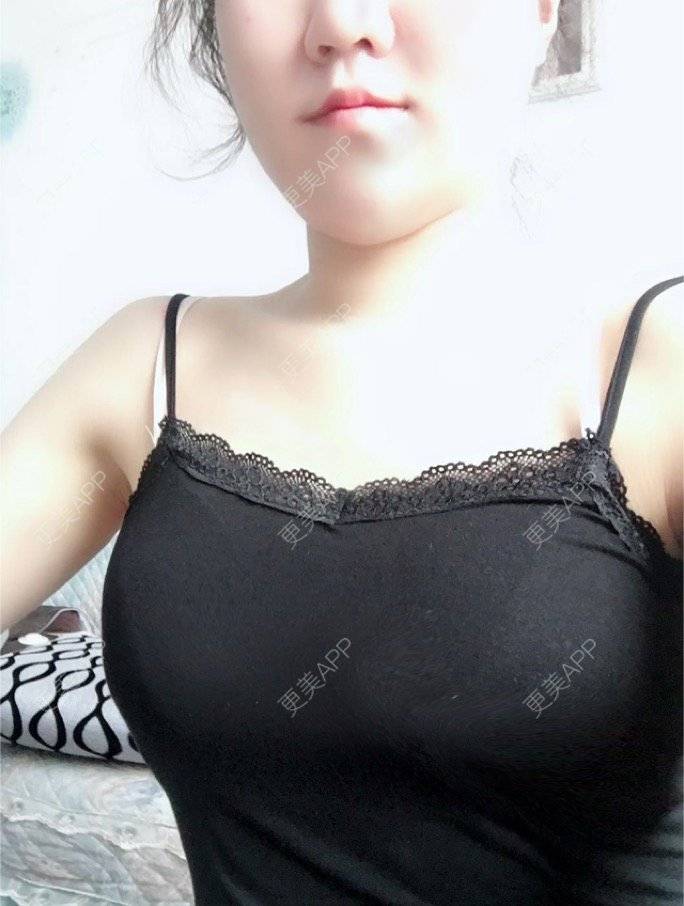 小夕瓜的自体脂肪隆胸日记