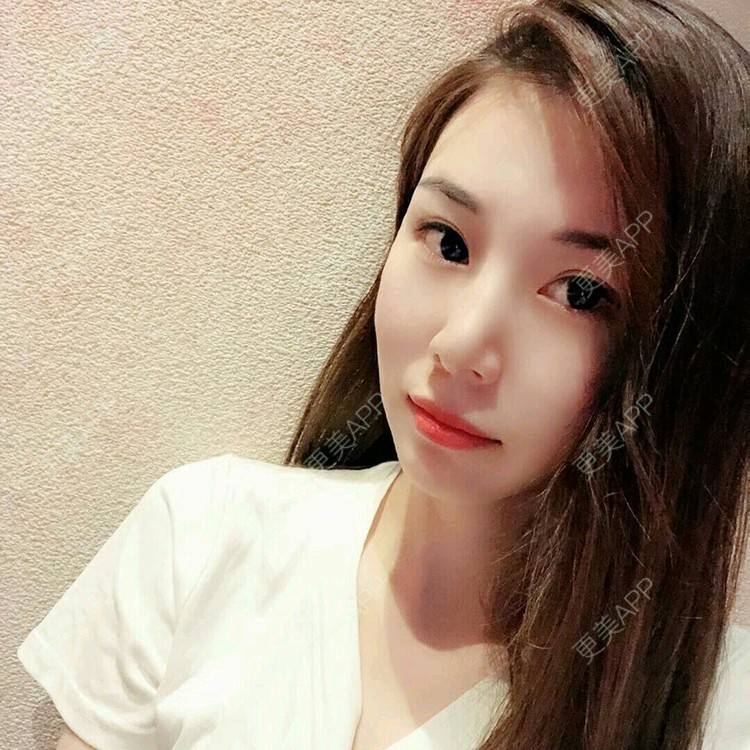 更美 - xNz3B婷的歪鼻矫正经验 | 上海 | 歪鼻矫正