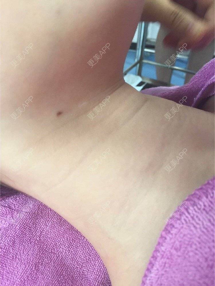 更美 - 喵喵兮！的玻尿酸颈纹经验 | 重庆 | 玻尿酸颈纹