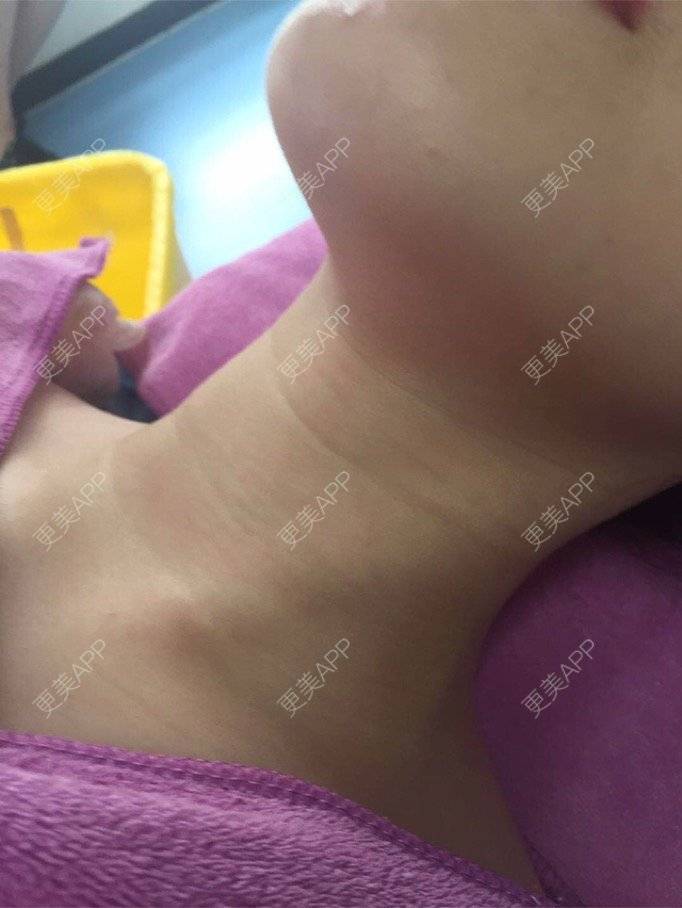 更美 - 喵喵兮！的玻尿酸颈纹经验 | 重庆 | 玻尿酸颈纹