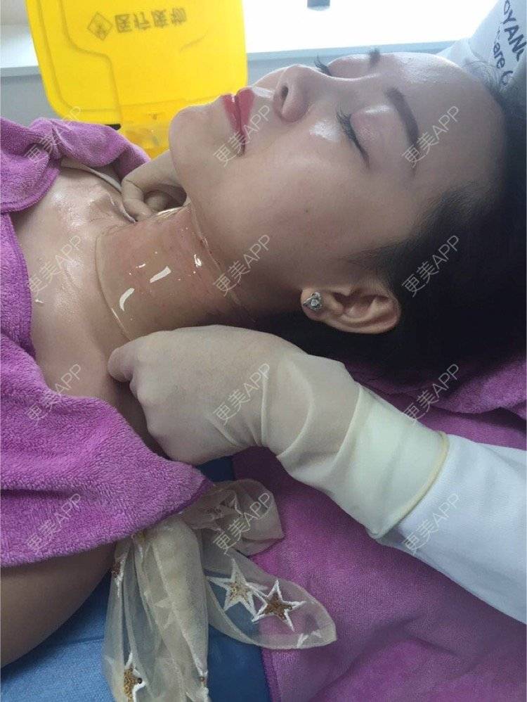 更美 - 喵喵兮！的玻尿酸颈纹经验 | 重庆 | 玻尿酸颈纹