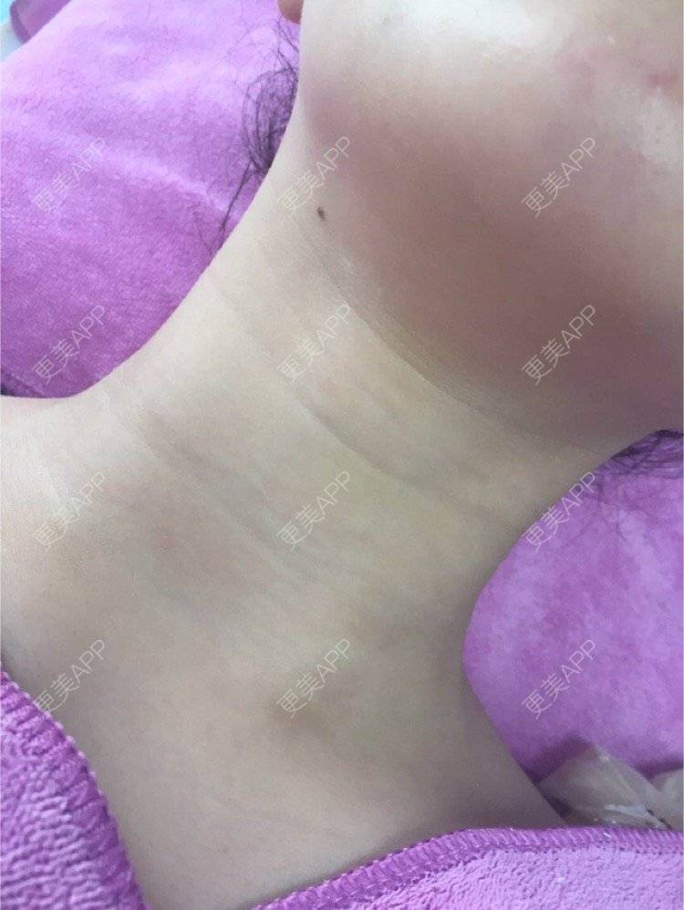 更美 - 喵喵兮！的玻尿酸颈纹经验 | 重庆 | 玻尿酸颈纹