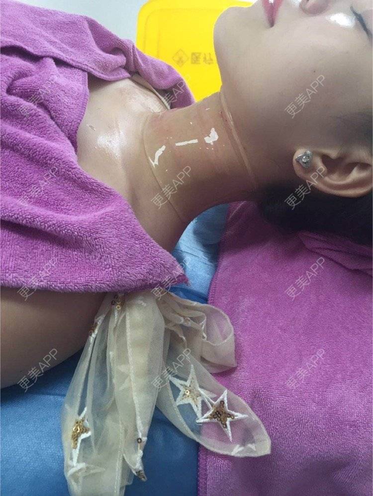 更美 - 喵喵兮！的玻尿酸颈纹经验 | 重庆 | 玻尿酸颈纹