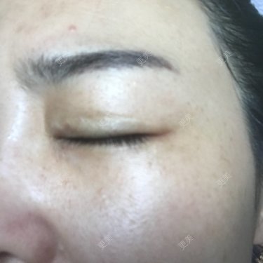 像素激光