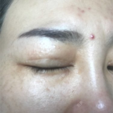 像素激光